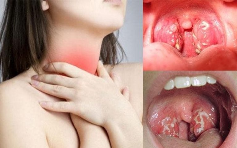 Viêm họng hạt có mủ và cách điều trị