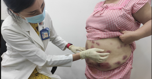 Tiêm tan mỡ bụng, người phụ nữ bị áp xe viêm, chảy mủ