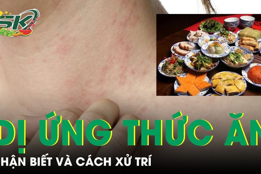 Dị ứng thức ăn ngày Tết: Nhận biết và cách xử trí