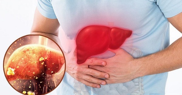 Điểm mặt những thực phẩm tồi tệ nhất cho sức khỏe lá gan