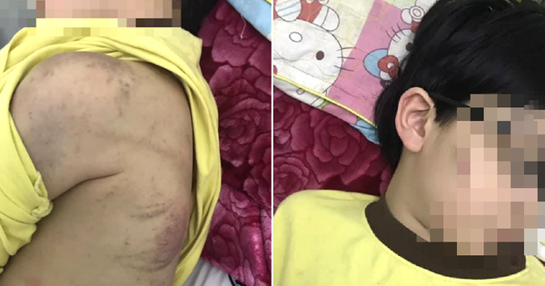 Nghi vấn, cháu bé 8 tuổi bị mẹ đánh nhập viện do chưa làm bài tập