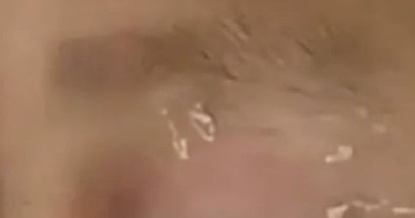 Cậu bé nhỏ keo 502 vào mắt, cách xử lý của người cha được bác sỹ khen ngợi