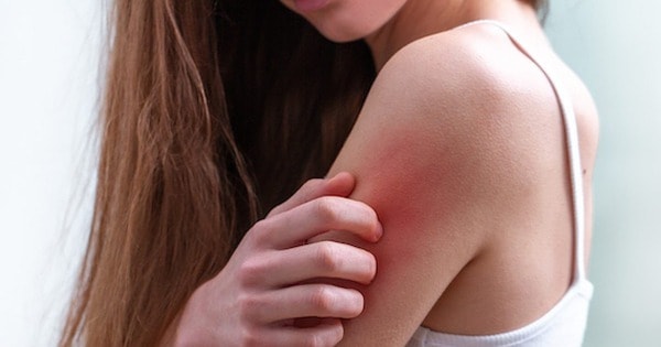 Thiếu hụt 5 dưỡng chất khiến da dễ khô nẻ