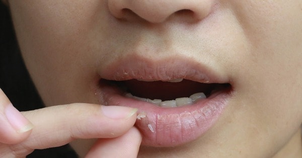 Ba thói quen đơn giản trị môi khô nẻ không cần son dưỡng