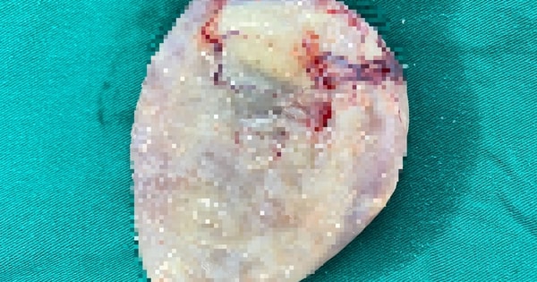 Hay ăn rau sống, gỏi cá người đàn ông nhiễm ấu trùng sán dây chó ký sinh tại phổi