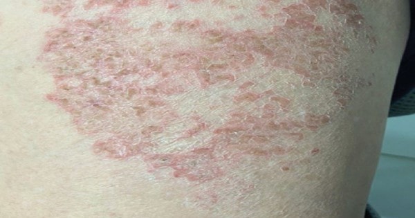 Người đàn ông ngứa dữ dội suốt 6 tháng không dứt, đi khám mới biết do thói quen nhiều người hay gặp