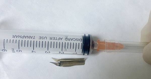 Nuốt phải ngòi bút máy, một bệnh nhi phải nhập viện khẩn cấp