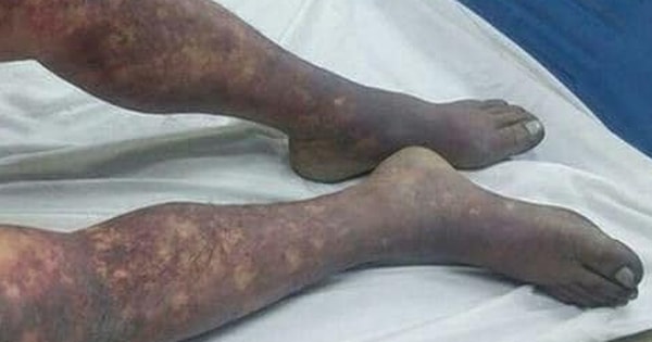 Ăn tiết canh lợn tất niên cuối năm, người đàn ông 50 tuổi tử vong