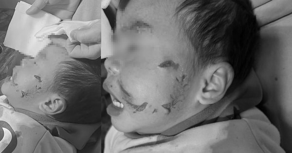 Phú Thọ: Bé trai 3 tuổi bị chó hàng xóm cắn ở vùng mặt gây tổn thương