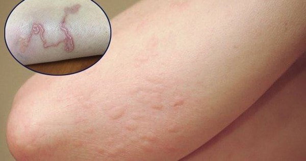 Người đàn ông 40 tuổi nhiễm giun sán chi chít trên người chia sẻ về thói quen ăn uống, trong đó có món nhiều người Việt thích mê