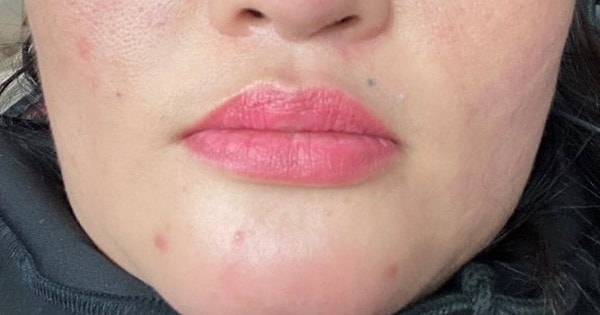 Tiêm filler làm đẹp chơi Tết, người phụ nữ 36 tuổi bị chảy dịch mủ trong miệng
