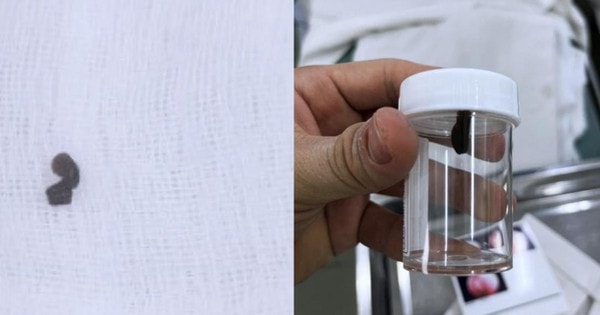 Bé 13 tháng tuổi phải mổ cấp cứu trong đêm khi phát hiện 'sinh vật lạ' lấp ló trong mũi