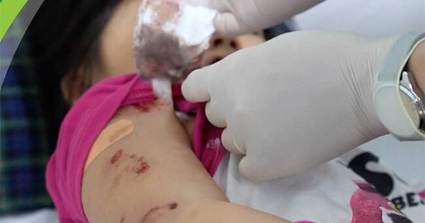 Bé gái 5 tuổi đang chơi bị chó cắn tới tấp, bác sĩ khuyến cáo cách phòng tránh bệnh dại từ vật nuôi