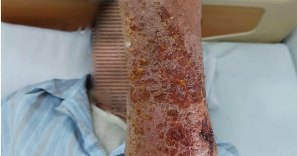 Người đàn ông phải nhập viện sau khi bị mèo cào