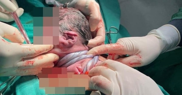 Em bé ở Hà Nội chào đời với dây rốn quấn 3 vòng cổ