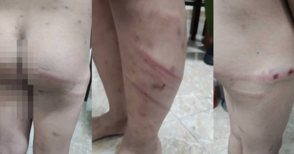 Phú Thọ: Bé trai 11 tuổi bị mẹ ruột và bạn trai bạo hành giữa đêm