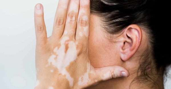 Phương pháp điều trị bệnh bạch biến