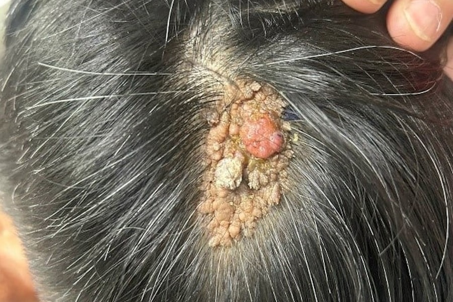 Vết bớt nhỏ trên đầu hoá ung thư ác tính