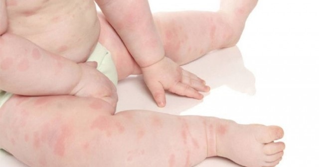 5 bệnh về da phổ biến ở trẻ và hậu quả khôn lường nếu mẹ lơ là