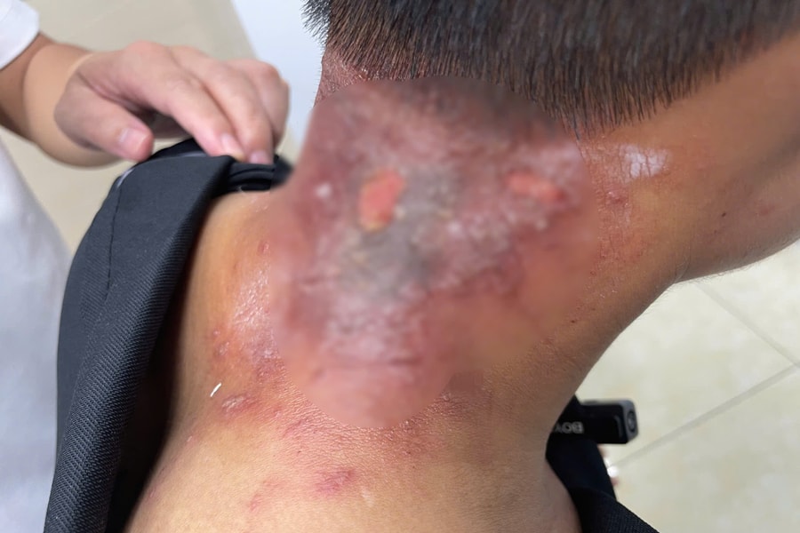 Lở loét da sau mưa lũ