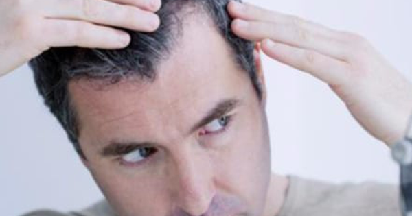 Nguyên nhân rụng tóc ở nam