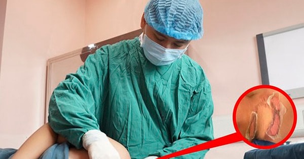 Gia tăng trẻ bị đuối nước, bỏng và ngộ độc trong dịp Tết, chuyên gia chỉ cách sơ cứu đúng để kịp thời cứu con