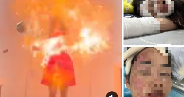 Cô gái bị bỏng mặt do nổ bóng bay gây sốc mạng xã hội