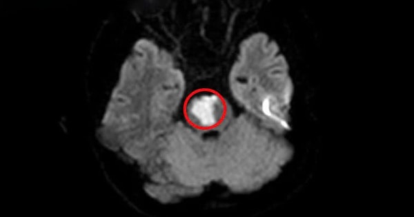 Bệnh nhân 17 tuổi bị nhồi máu não, thừa nhận phạm sai lầm nhiều người Việt dễ mắc phải