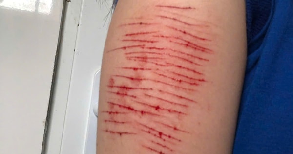 Thiếu nữ 15 tuổi tự rạch tay gây thương tích phải nhập viện, đâu là lý do?