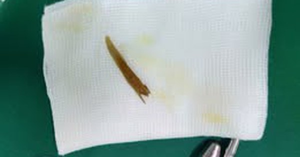 Nuốt phải xương gà, nhiều người bị thủng ruột non