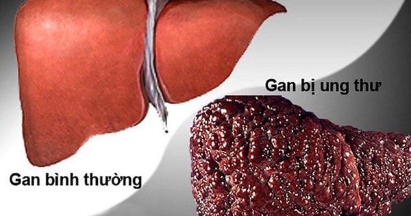 Lên mạng tìm thầy chữa ung thư gan, người đàn ông 37 tuổi ở Hà Nội qua đời trong sự đau xót của người thân