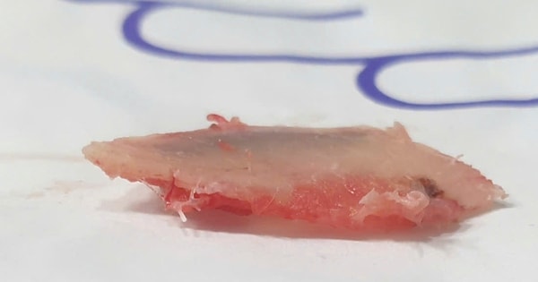 Người đàn ông bị xương sườn đâm thủng phổi