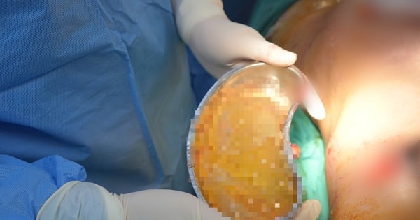 Thai phụ bị vỡ túi nâng ngực, chuyên gia chỉ rõ những nguyên nhân khiến túi ngực có thể vỡ