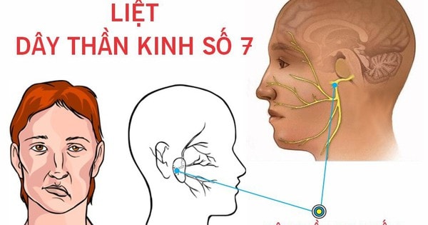 Thanh niên 27 tuổi ở Hà Nội bất ngờ bị liệt nửa mặt, bác sĩ chỉ rõ 'thủ phạm'
