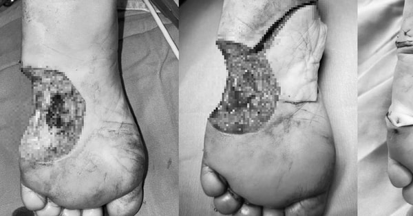 Người phụ nữ ở Hà Nội suýt phải cắt cụt chân chỉ vì một nốt ruồi nhỏ