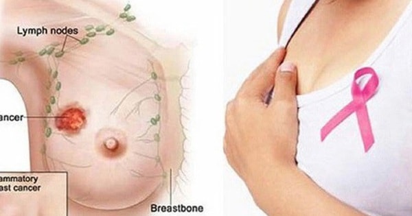 Thấy bất thường ở ngực, người phụ nữ 38 tuổi ở Hà Nội đi khám bất ngờ phát hiện khối u hiếm gặp