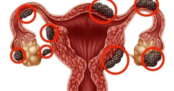 Người phụ nữ 47 tuổi ở Bắc Ninh phải nhập viện phẫu thuật cắt tử cung từ dấu hiệu nhiều chị em Việt mắc phải