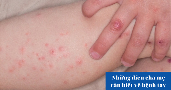Những điều cha mẹ cần biết về bệnh tay chân miệng ở trẻ nhỏ