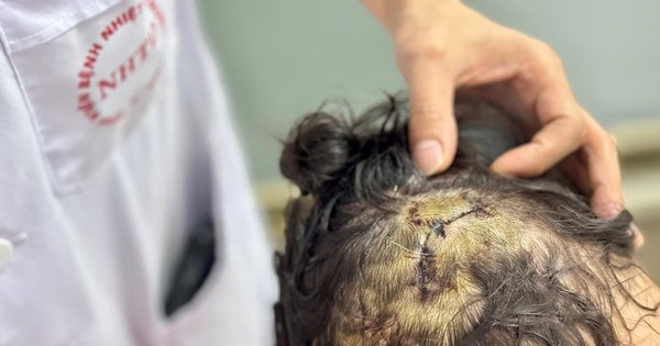 Thương tâm bé gái 5 tuổi bị chó nhà nặng hơn 20kg tấn công vào vùng đầu