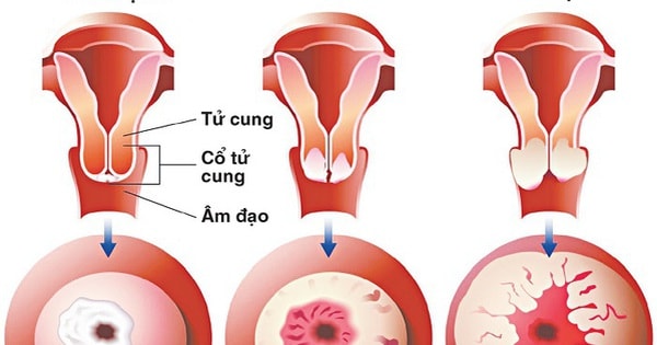 Chị em cần biết điều này trước khi làm tầm soát ung thư cổ tử cung