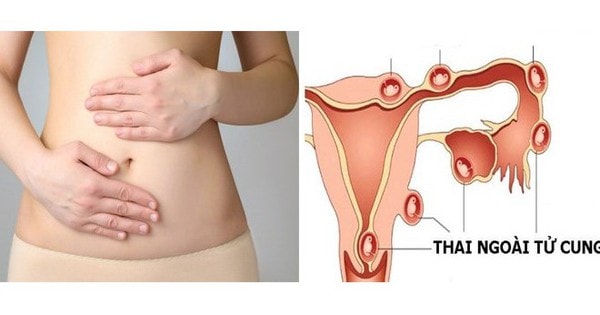 Người phụ nữ 36 tuổi nhập viện vì thai ngoài tử cung vỡ, thừa nhận một sai lầm nhiều phụ nữ Việt mắc phải