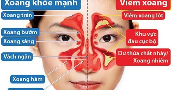 Cảnh báo nguy cơ viêm mũi xoang cấp từ một sai lầm nhiều người Việt mắc phải