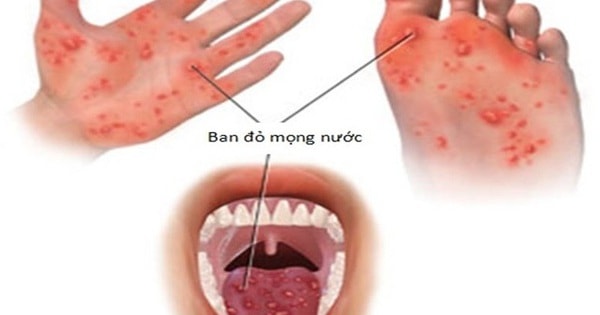 Bệnh tay chân miệng đang gia tăng, bố mẹ cần biết điều này để bảo vệ con