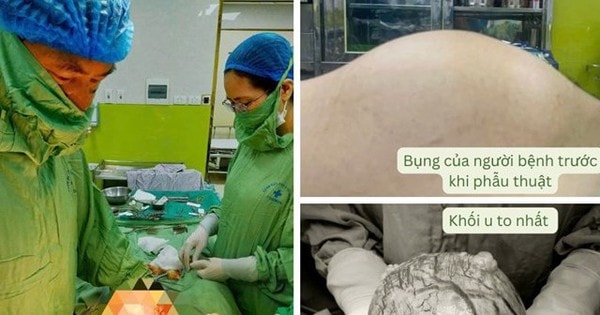 Người phụ nữ 42 tuổi ở Hòa Bình có khối u 'khủng' như mang thai 3 tháng từ sai lầm nhiều chị em Việt mắc phải