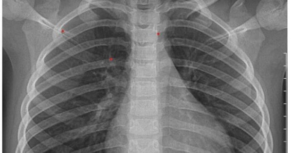 Bé 3 tuổi ở Hà Nội đối diện với loạt biến chứng nguy hiểm do cúm B từ dấu hiệu nhiều trẻ em Việt mắc phải