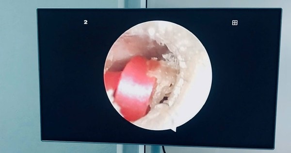 Bé gái 6 tuổi đi viện do sợi dây chun buộc tóc