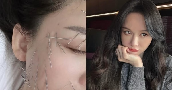 Tranh cãi chuyện nữ diễn viên nổi tiếng găm cả trăm cây kim lên mặt để 'trẻ mãi không già'