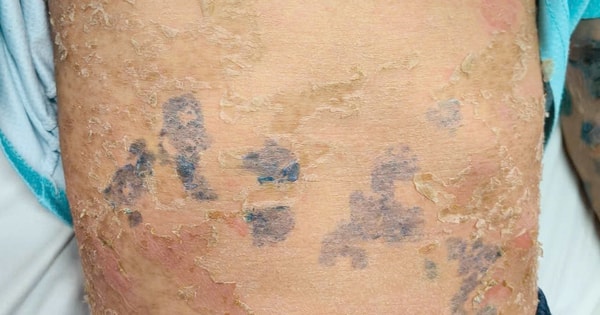 Nam thanh niên 17 tuổi nhập viện do điều trị sởi sai cách, bác sĩ chỉ rõ sai lầm gây biến chứng nguy hiểm