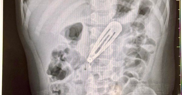 Bé gái 21 tháng tuổi nhập viện gấp với chiếc kẹp tóc trong dạ dày