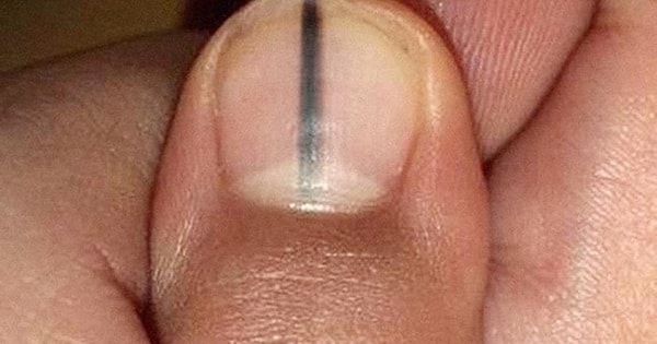 Nếu móng tay có dấu hiệu này, cẩn thận với ung thư hắc tố